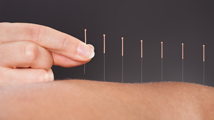 Akupunktura: dlaczego to działa?