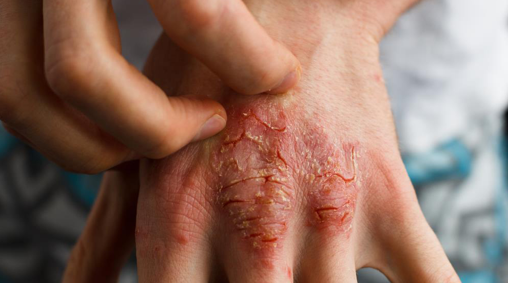 Ukryte obciążenia związane z egzemą: Jak stan zapalny, dieta i zdrowie psychiczne wpływają na atopowe zapalenie skóry