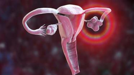 Co zrobić, jeśli zdiagnozowano u Ciebie torbiel jajnika