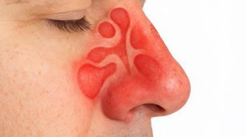 Naturalne metody leczenia zapalenia zatok, które naprawdę działają