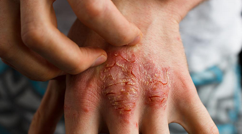 Dziesięć prostych i naturalnych sposobów leczenia egzemy