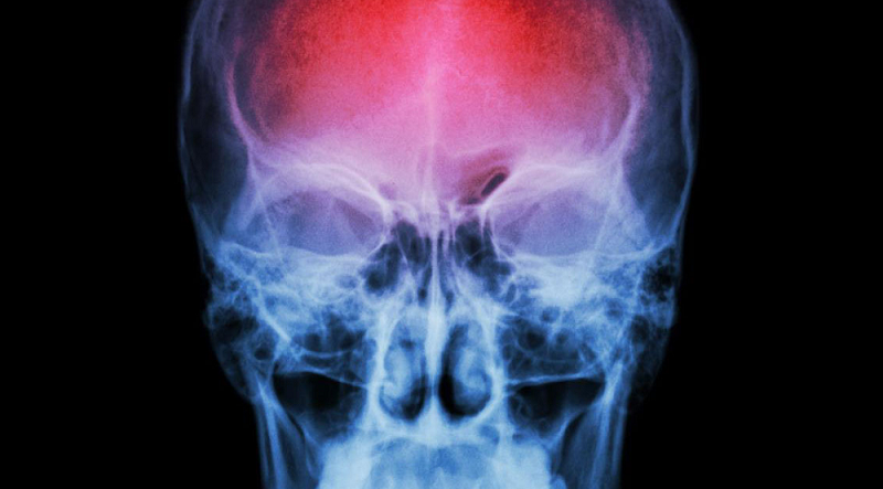 Przełomowe badania pokazują, że spowolnienie procesu starzenia się organizmu może radykalnie zmniejszyć ryzyko udaru mózgu